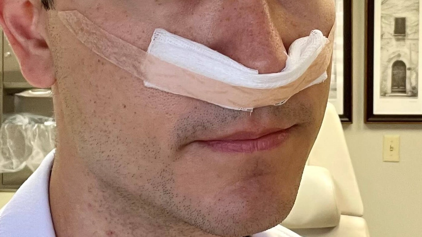 Tips on how to prepare the perfect mustache dressing following nasal surgery